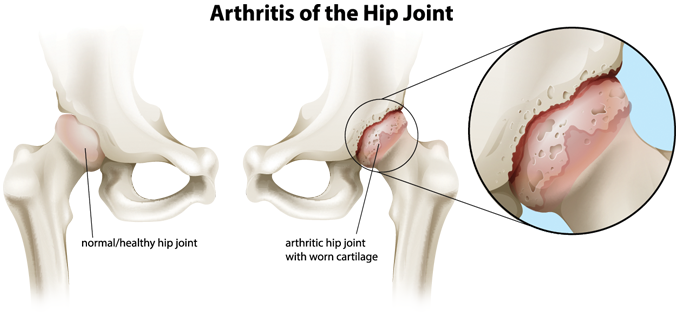 Diagram of arthritis of the hip joint